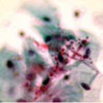 Normal squamous cells with candida spp. (veast)