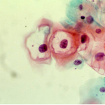 Atypical cells with human papilloma virus effect (Low grade squamous intraepithelial lesion)